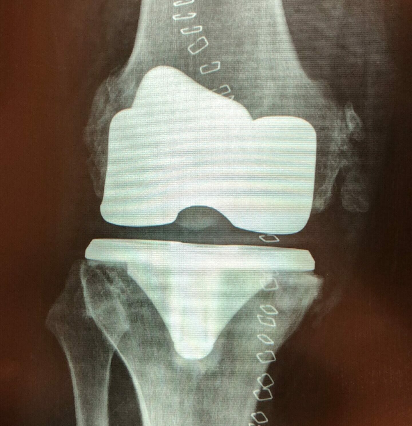Chirurgo Ortopedico Cremona - protesi ginocchio